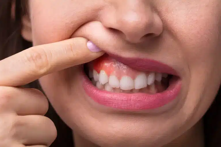 التهاب لثه می‌تونه بر مغز تأثیر منفی بذاره