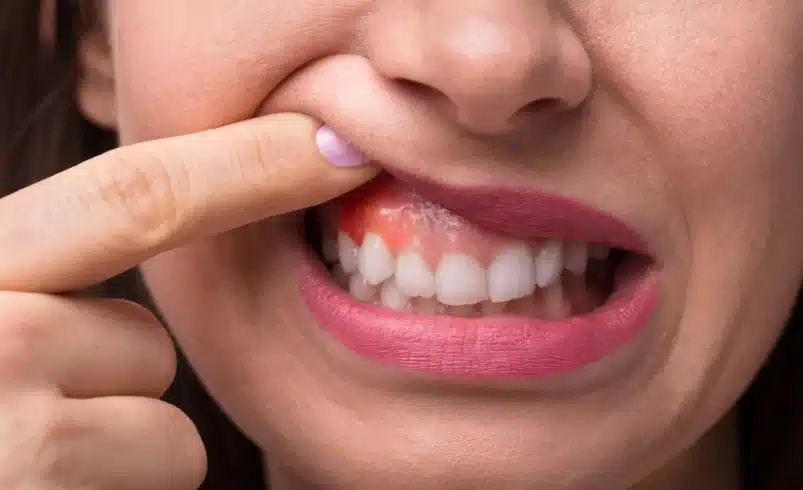 التهاب لثه می‌تونه بر مغز تأثیر منفی بذاره