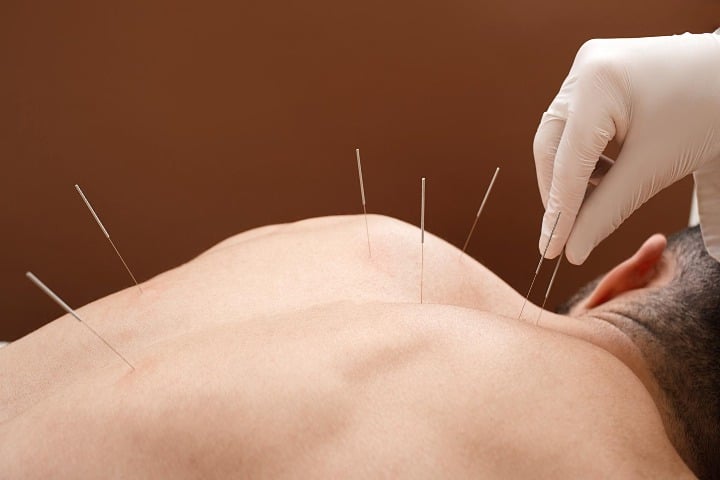 همه چیز درباره طب سوزنی