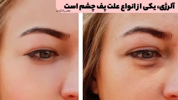 آلرژی، یکی از انواع علت پف چشم است