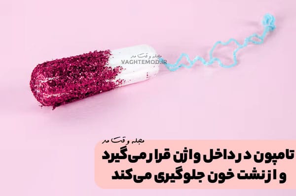 تامپون (Tampon)، در داخل واژن قرار میگیرد و از نشت خون جلوگیری میکند