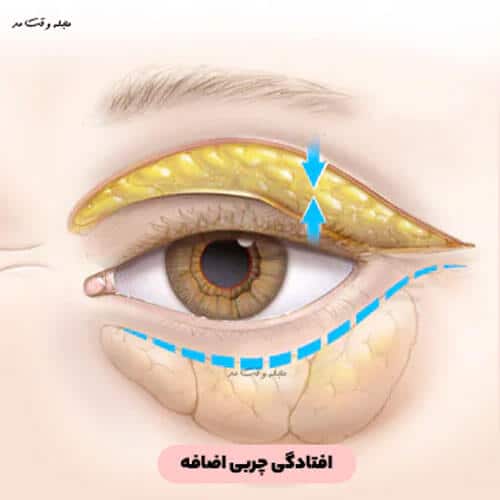 علت و درمان خانگی پف زیر چشم