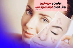 بهترین و سریعترین روش‎ درمان جوش زیر پوستی! همه حقایق مهم درمورد درمان جوش کیستیک