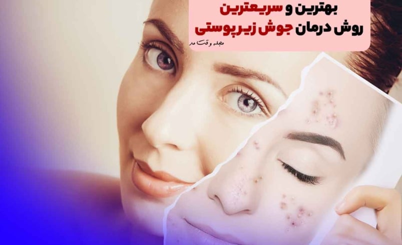 بهترین و سریعترین روش‎ درمان جوش زیر پوستی! همه حقایق مهم درمورد درمان جوش کیستیک