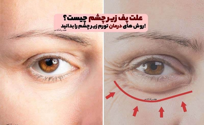 علت پف زیر چشم چیست؟ روش های درمان تورم زیر چشم را بدانید!