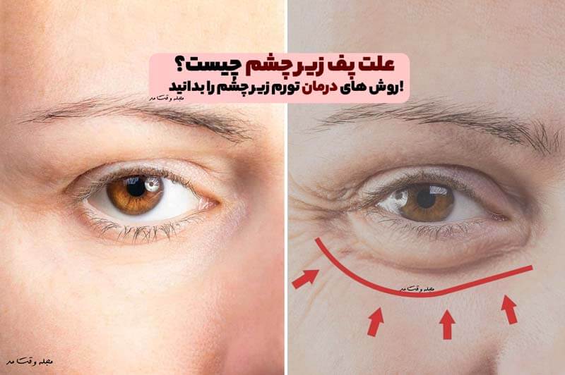 علت پف زیر چشم چیست؟ روش های درمان تورم زیر چشم را بدانید!