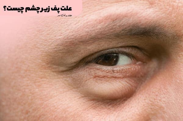 انواع علت پف زیر چشم