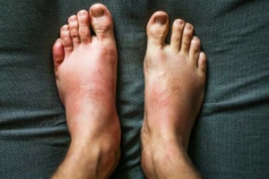 نقش رژیم گیاهی در کاهش التهاب: نگاهی علمی به زیان‌های مصرف محصولات حیوانی