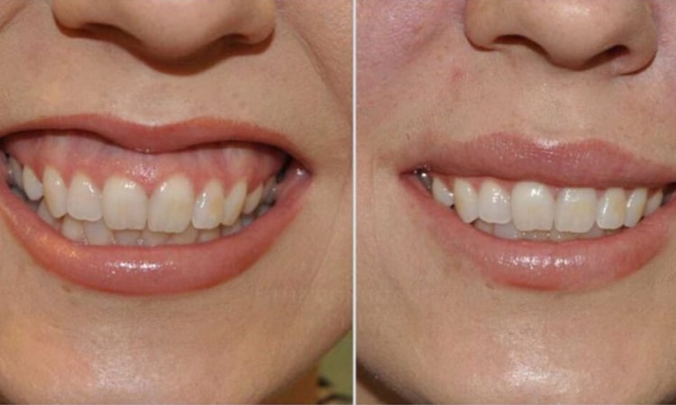 اصلاح لبخند لثه ای