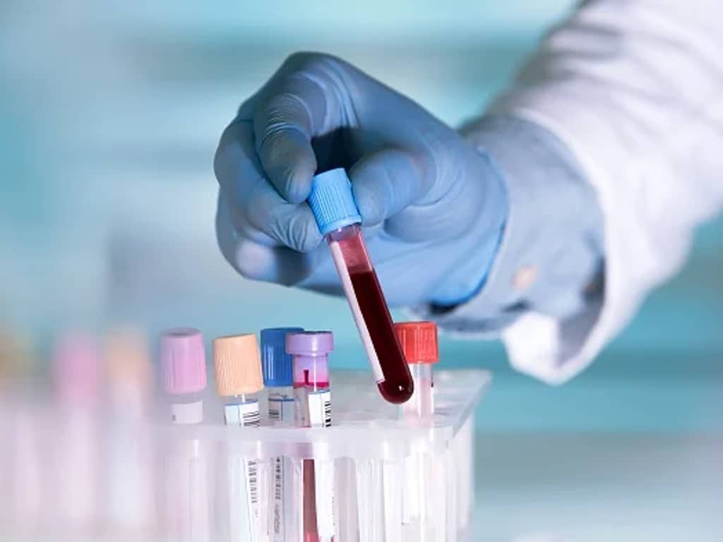 علائم سکته قلبی در آزمایش خون