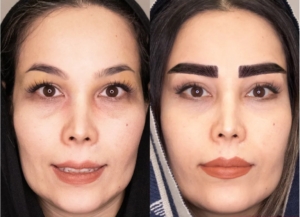 کاشت ابرو بدون جراحی در بهترین کلینیک کاشت ابرو غرب تهران