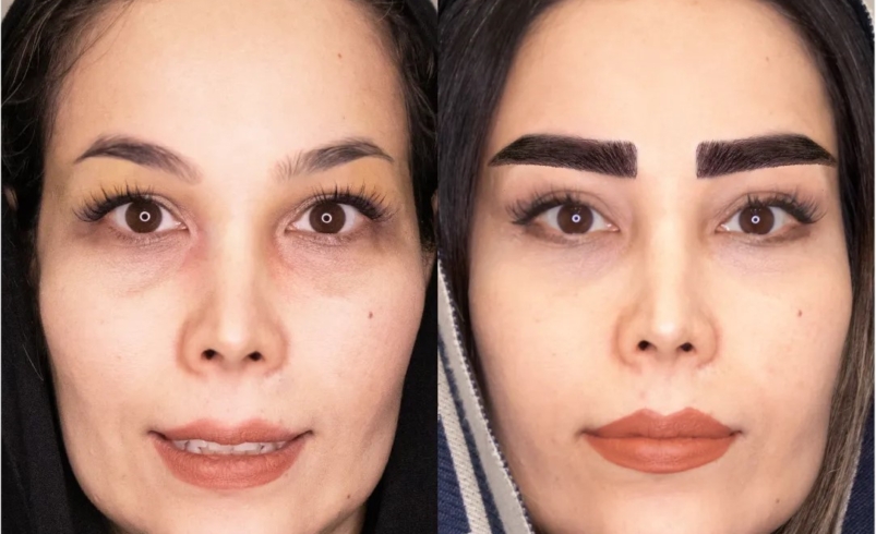 کاشت ابرو بدون جراحی در بهترین کلینیک کاشت ابرو غرب تهران