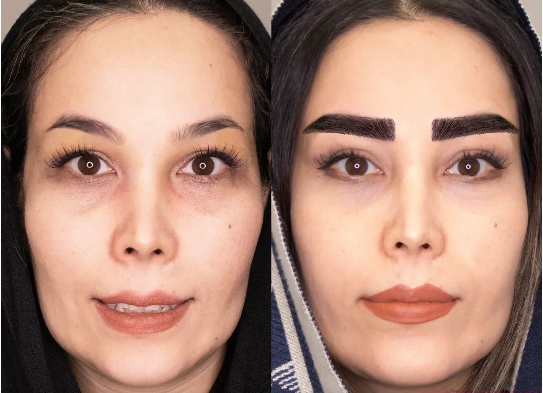 کاشت ابرو بدون جراحی در بهترین کلینیک کاشت ابرو غرب تهران
