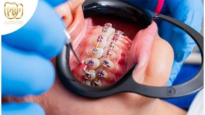 آیا ارتودنسی باعث پوسیدگی دندان می‌شود؟