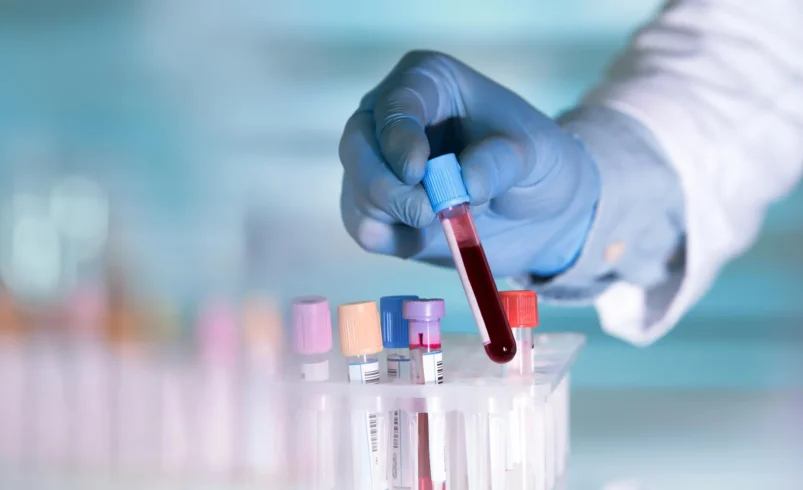هشدار زودهنگام کرون با یک آزمایش خون ساده
